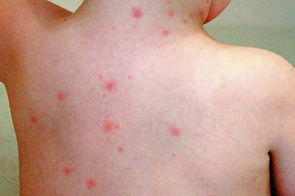 Registran notable aumento de las enfermedades eruptivas en nintildeos