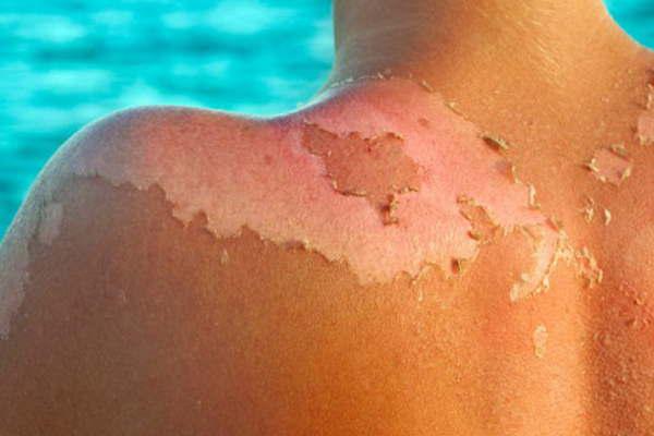 Por la mala exposicioacuten al sol crecieron considerablemente las consultas por lesiones en la piel