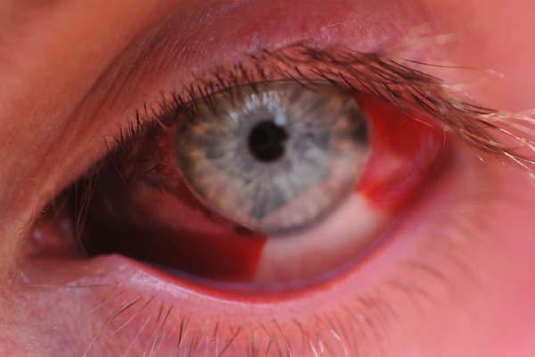 Lesiones oculares- coacutemo identificarlas y tratarla