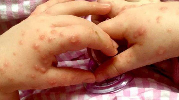 La roseacuteola varicela y ldquomano pie bocardquo entre las patologiacuteas a las que los estudiantes maacutes pequentildeos estaacuten maacutes expuestos durante el ciclo escolar