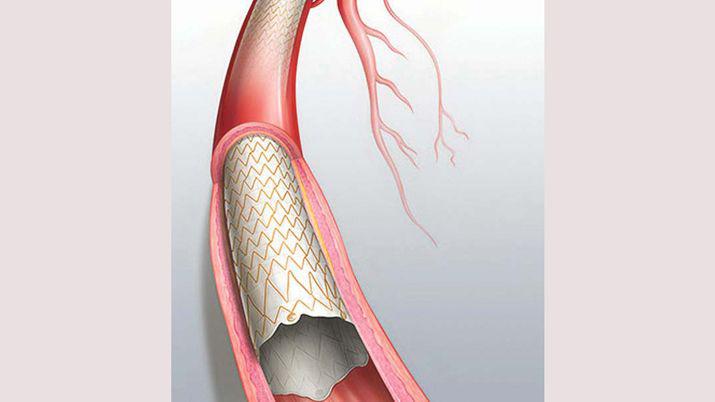 iquestQueacute es un stent coronario