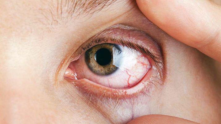 iquestQueacute es y coacutemo afecta una mancha de sangre en el ojo