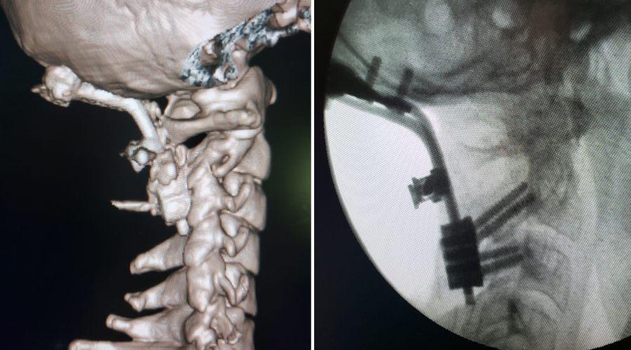 Logro- realizaron una operacioacuten de altiacutesimo riesgo en el Regional