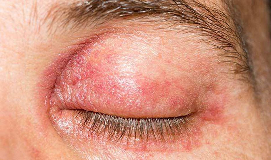 Queacute es y coacutemo se controla la blefaritis