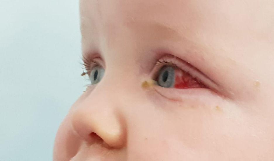 Conjuntivitis pediaacutetrica