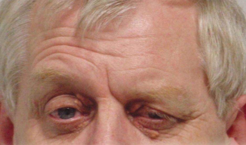 Ptosis palpebral patologiacutea oftalmoloacutegica en donde intervienen nuestros pares craneales