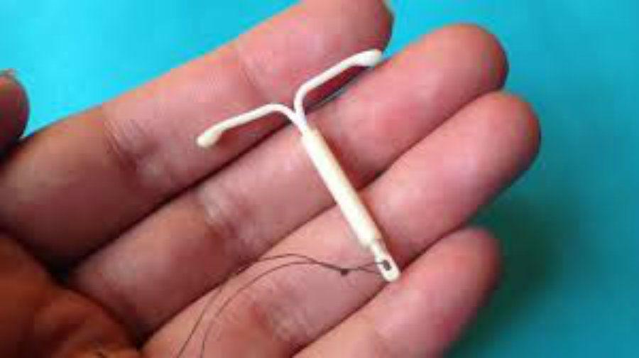 Un bebe nacioacute con un DIU en la cabeza