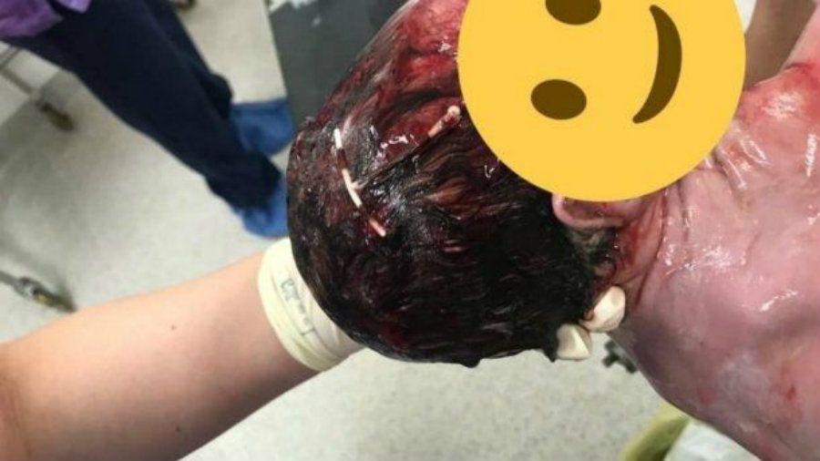 Un bebe nacioacute con un DIU en la cabeza