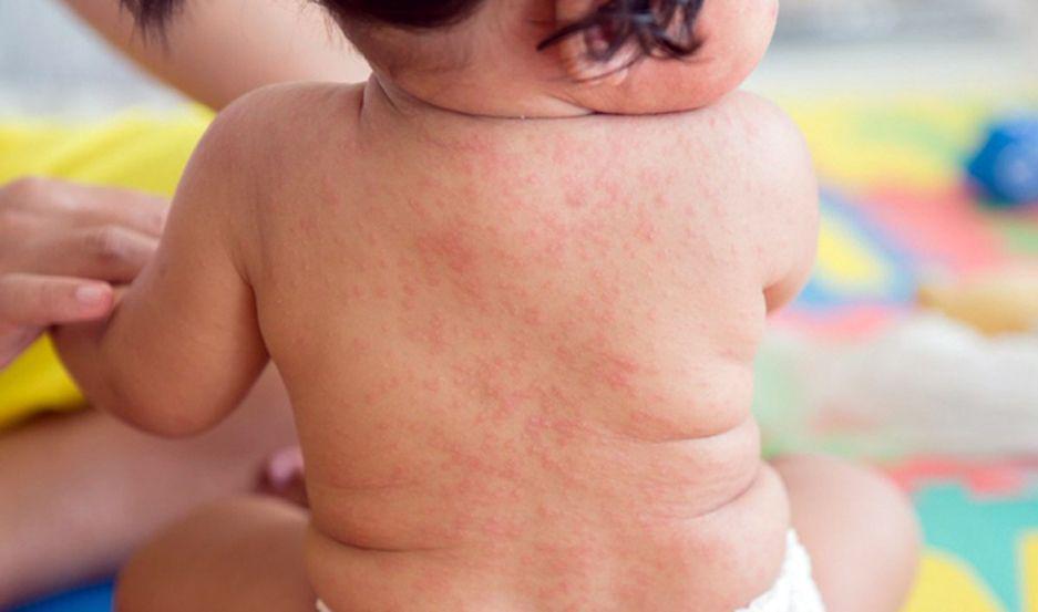 Alertan que puede haber maacutes casos de sarampioacuten y llaman a vacunarse