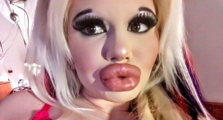 Se operoacute los labios para tenerlos maacutes grandes y se deformoacute la cara