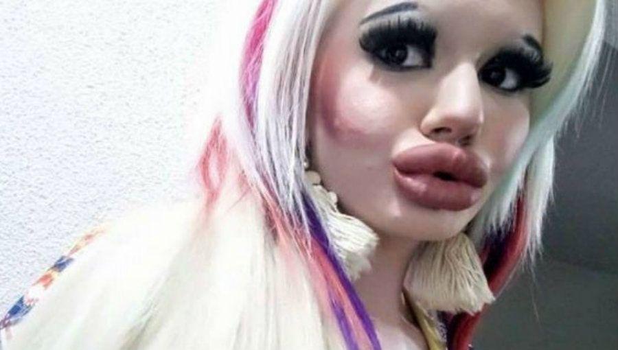 Se operoacute los labios para tenerlos maacutes grandes y se deformoacute la cara