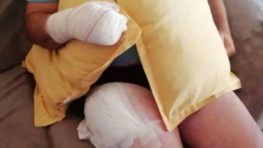 Le explotoacute el celular en el pantaloacuten provocaacutendole grandes heridas