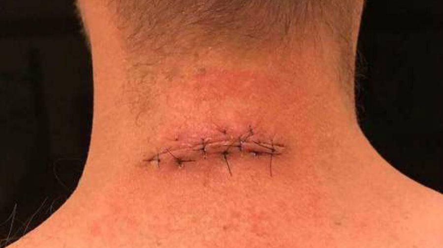 Casi pierde parte del cuello y de la espalda por una mancha