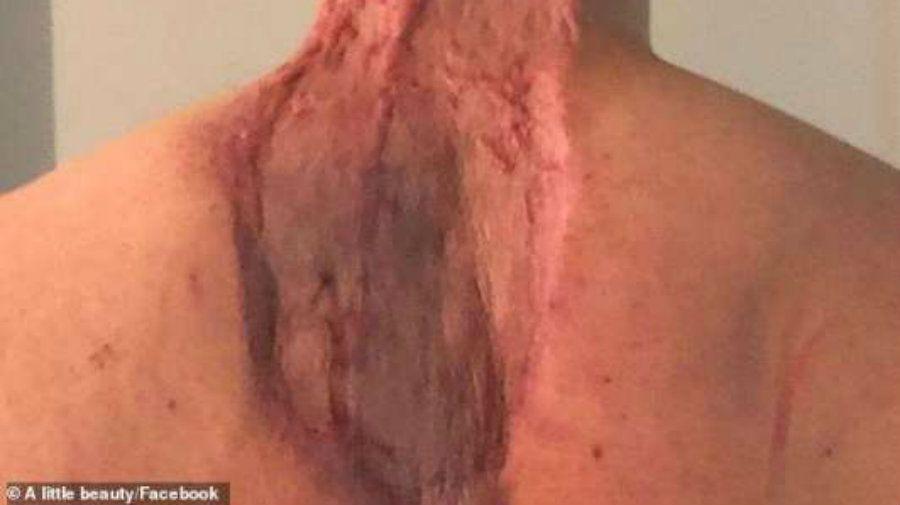 Casi pierde parte del cuello y de la espalda por una mancha