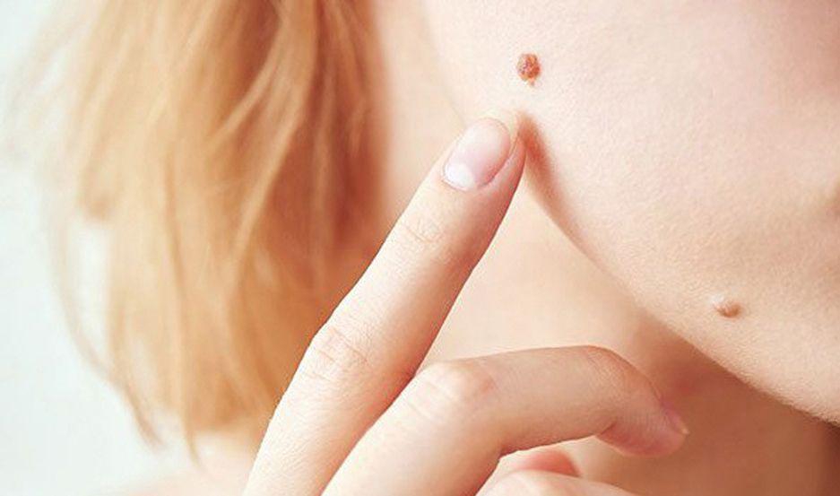 Hay que prestar especial atención a los lunares que se encuentran en las zonas ms expuestas al sol
