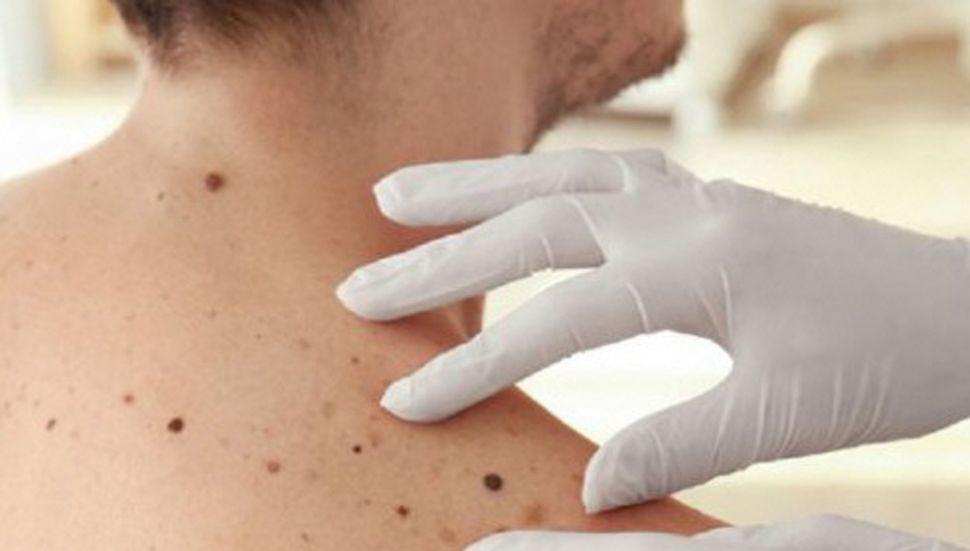 Las lesiones en la piel tienen que ver con la exposición al sol y a las luces artificiales