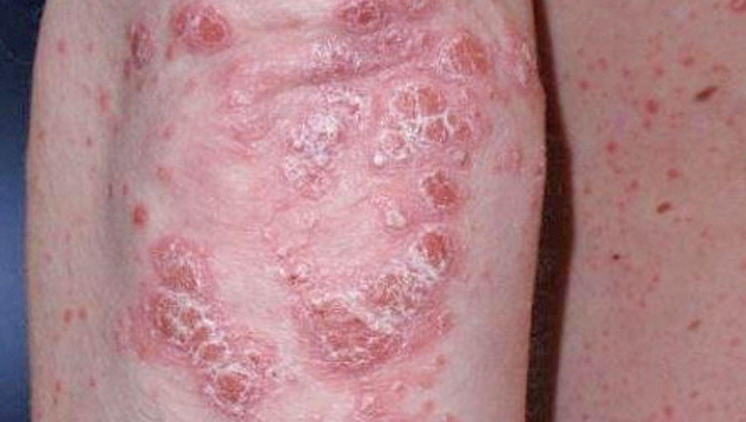 La psoriasis es una enfermedad inflamatoria crónica y recurrente y multifactorial