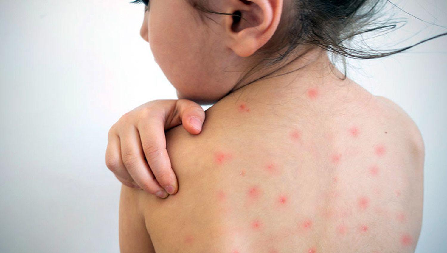 El mayor n�mero de casos confirmados de sarampión corresponde a menores de 1 año de edad