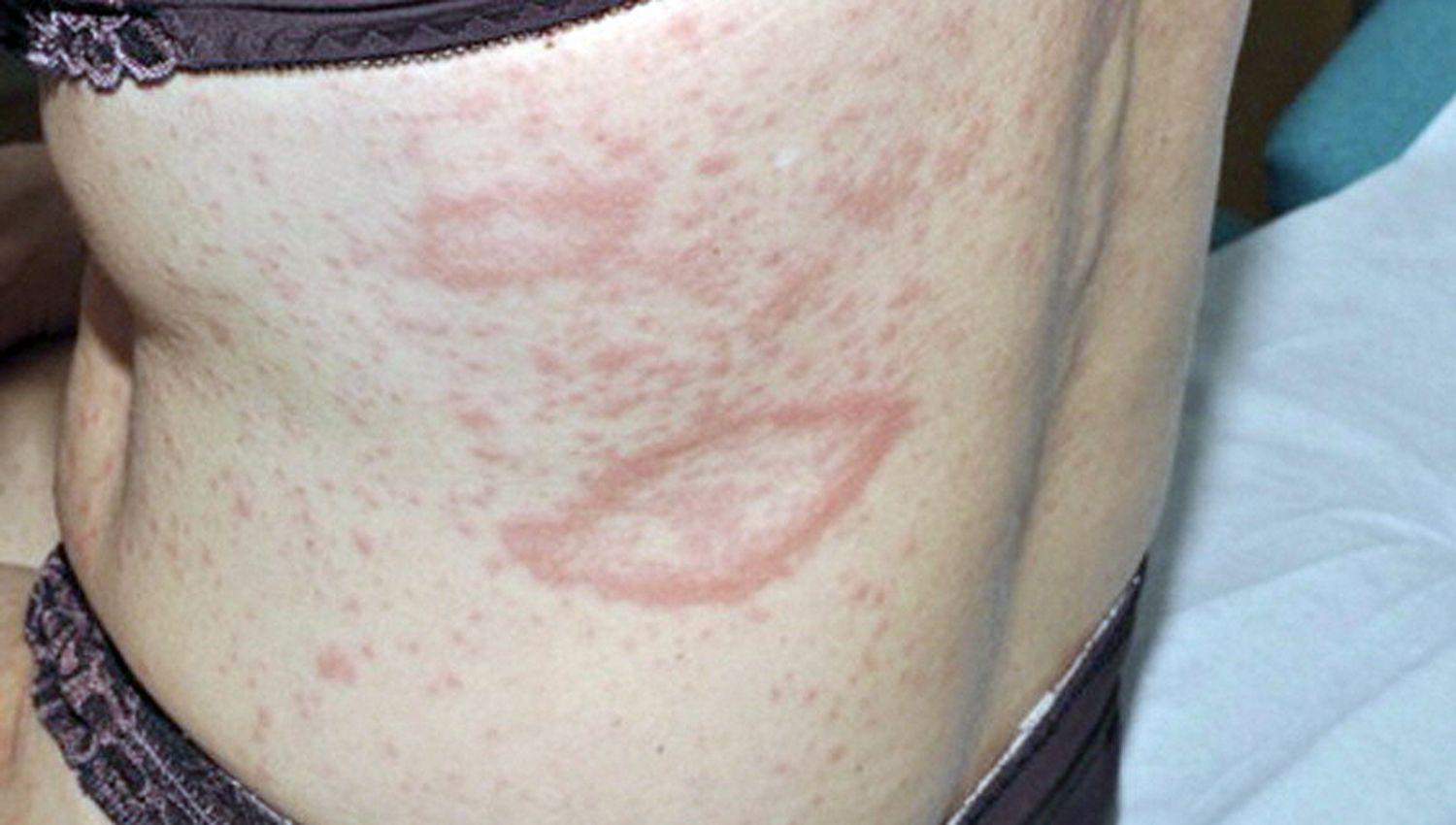 Alertan por dermatosis que no siempre es bien diagnosticada