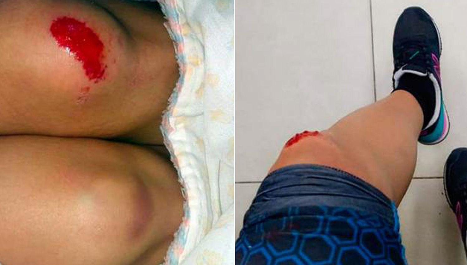 La joven sufrió diversas heridas en sus piernas por la caída de su bicicleta