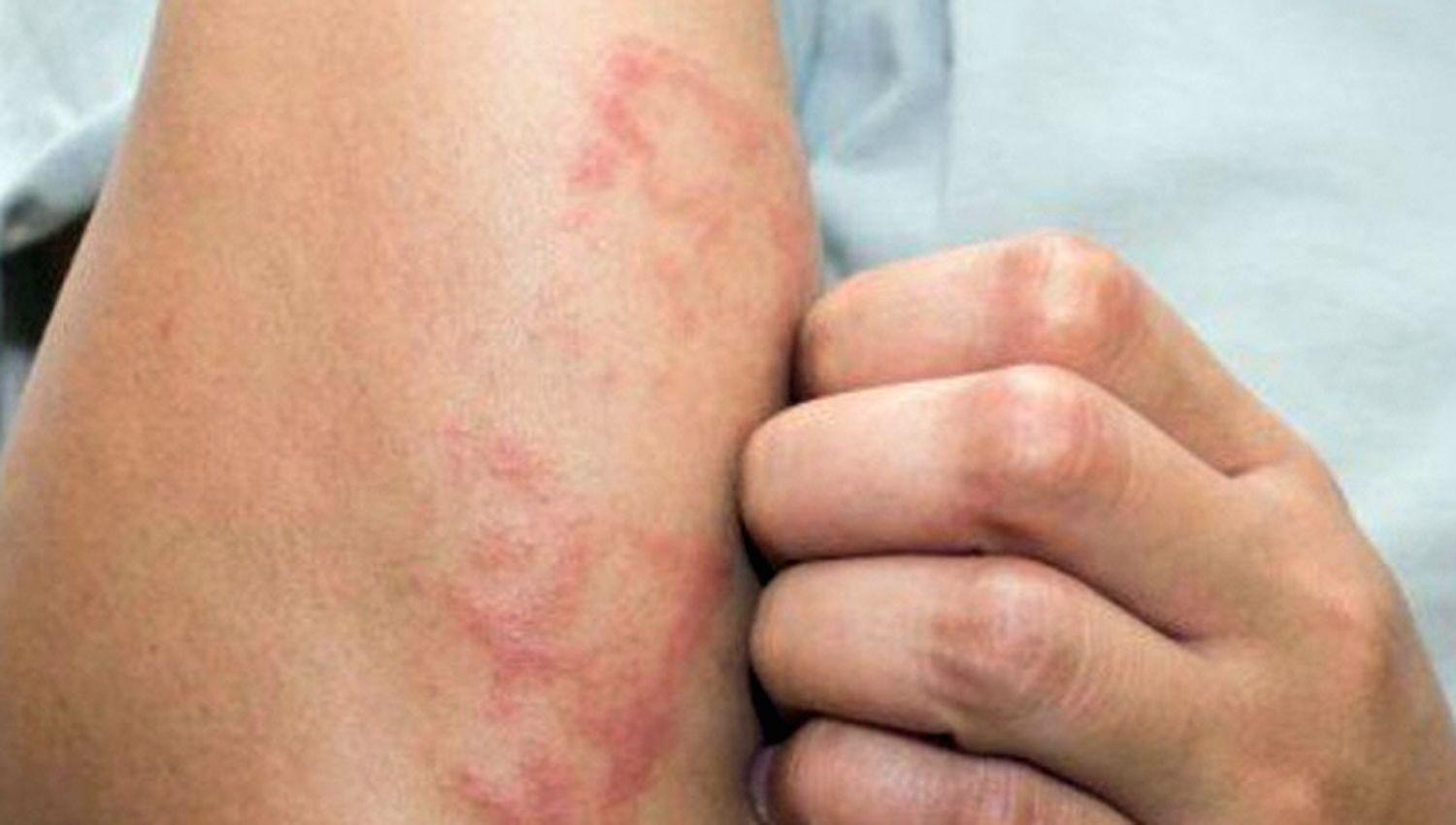 Especialistas aseguran que la lepra continuacutea siendo un serio problema en nuestro paiacutes