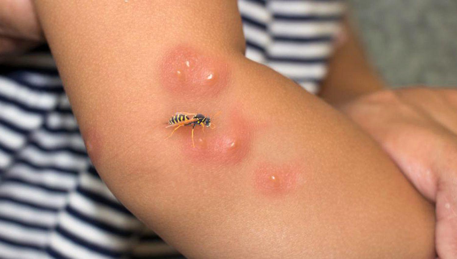 Una picadura puede generar desde picazón hasta vómitos y fiebre