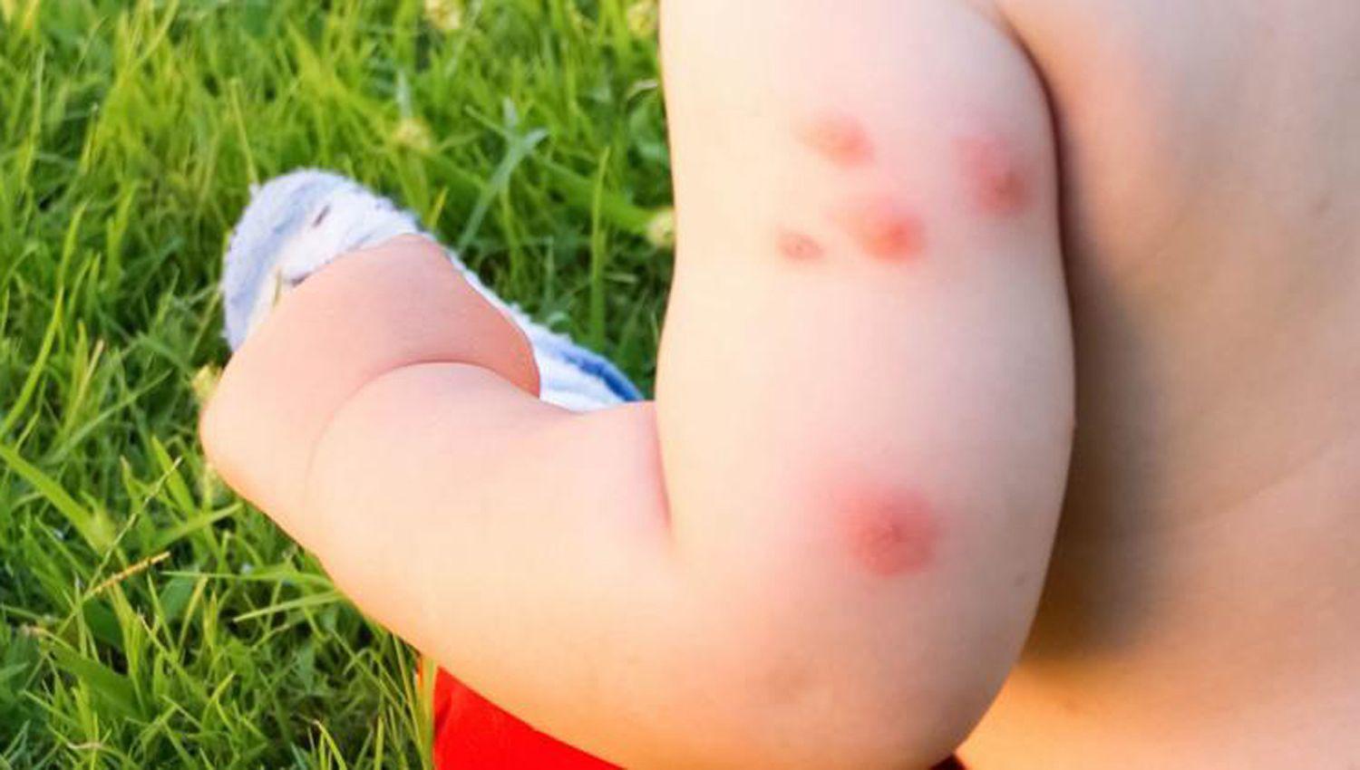 Las picaduras de los mosquitos  generan importantes lesiones en la piel y cuadros complejos en caso de dengue