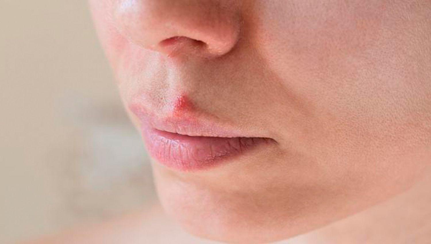 Cientiacuteficos neutralizan el virus herpes con compuesto vegetal en laboratorio