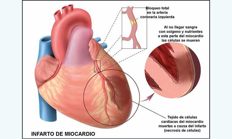 Queacute es el infarto agudo de miocardio o ataque al corazoacuten