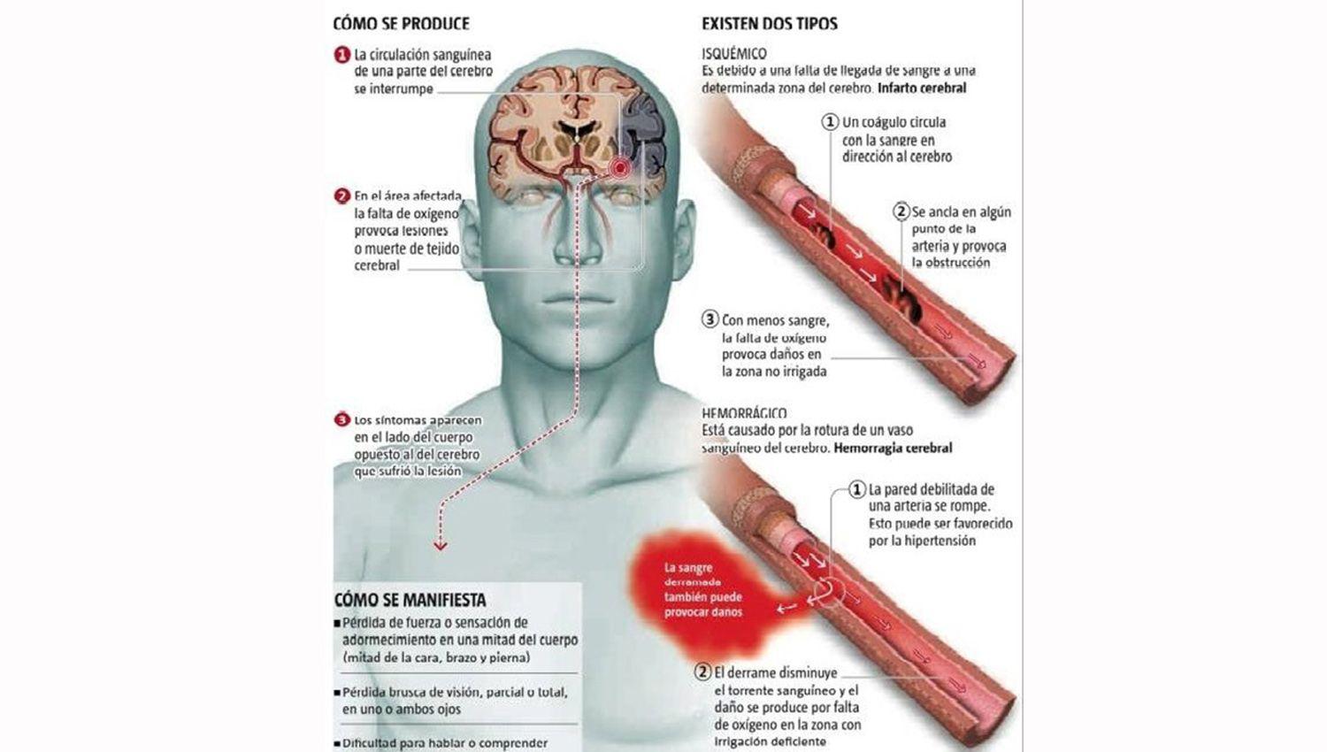 Alerta- los factores de riesgo de un ACV son los mismos que complican un cuadro de Covid-19