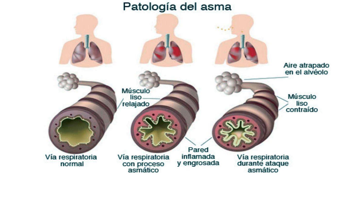 ldquoEl asmaacutetico puede hacer una vida normal siempre que siga el tratamientordquo