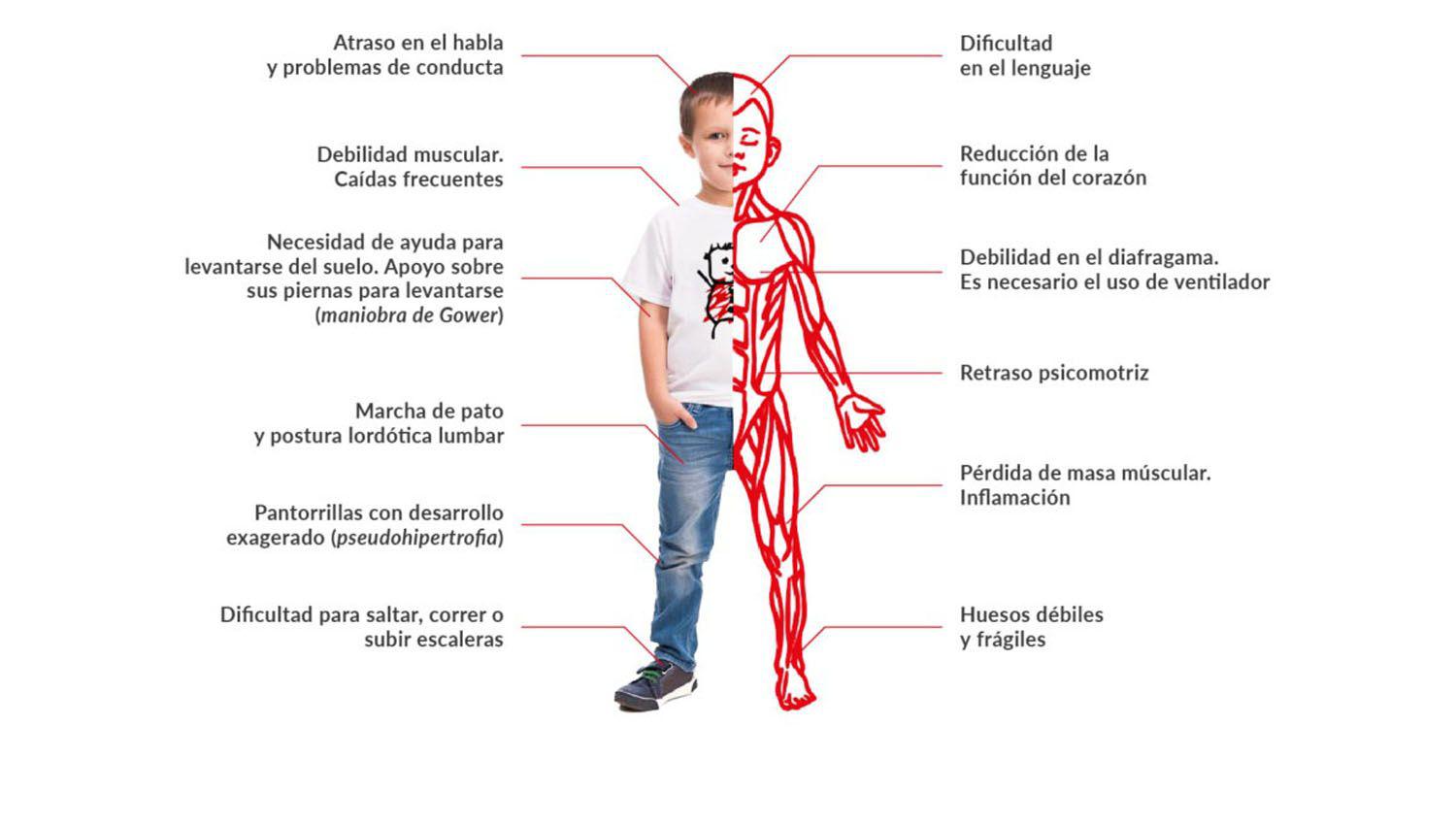 Organizan para mantildeana la Jornada de Distrofia Muscular de Duchenne