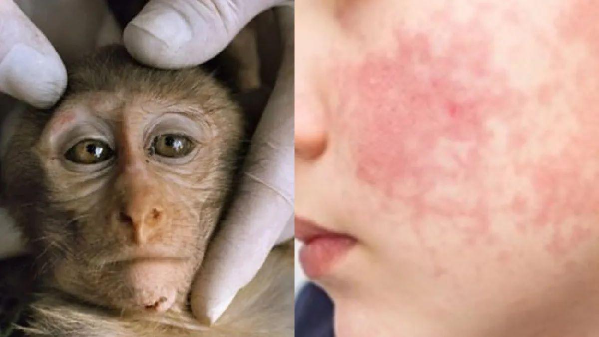 Confirman maacutes casos de viruela del mono- cuaacuteles son los siacutentomas y coacutemo se transmite