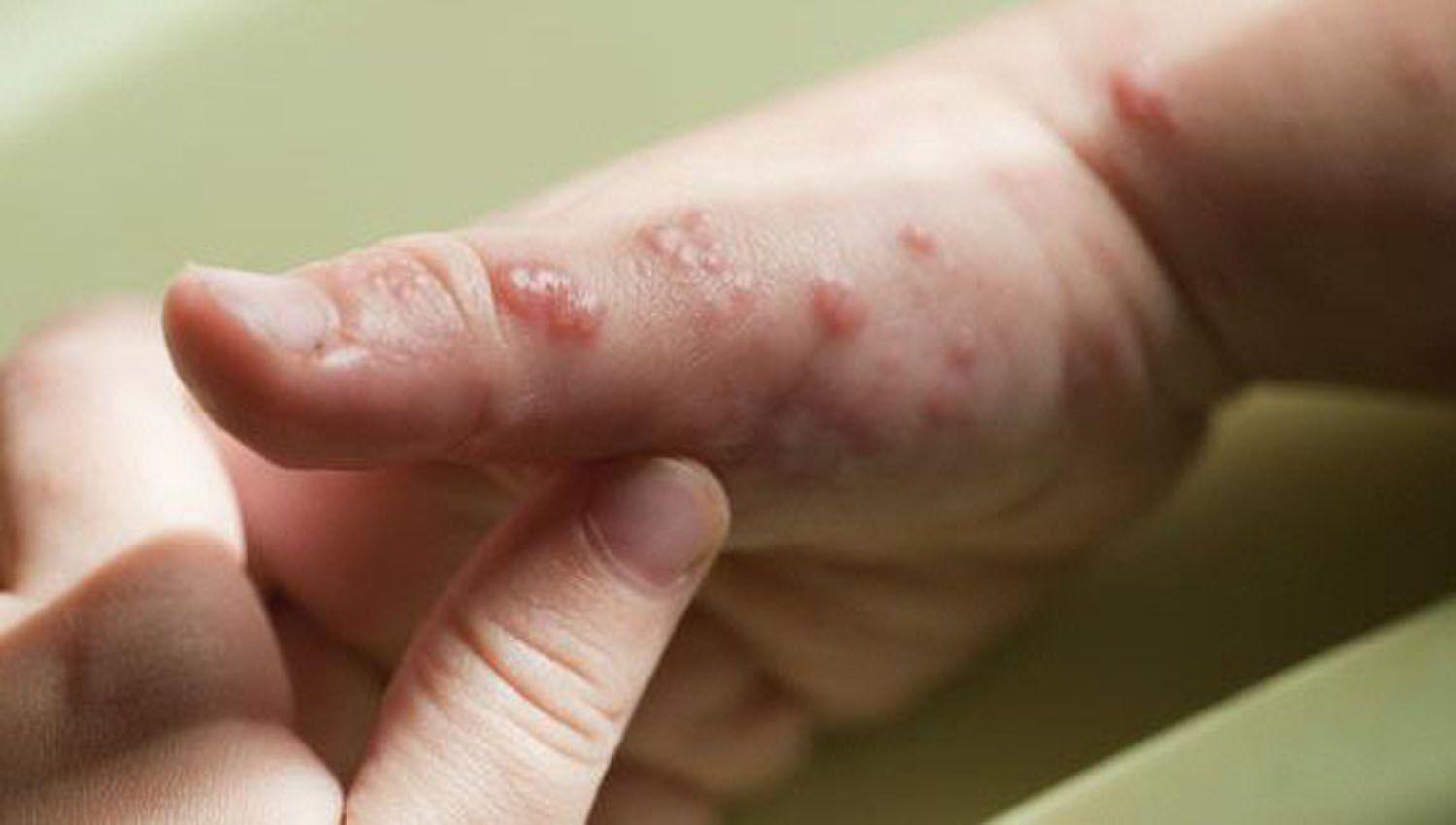 Queacute cuidados debe tener la poblacioacuten como prevencioacuten de la enfermedad