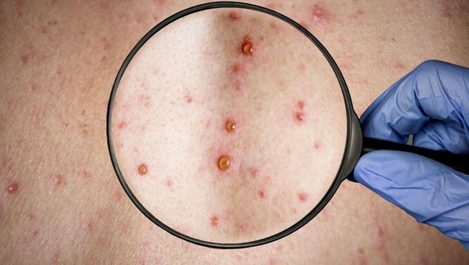 Confirman el segundo caso de viruela del mono en la Argentina