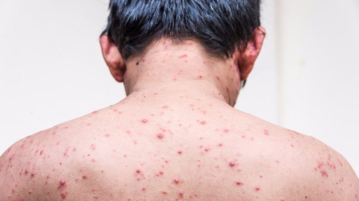 Viruela del mono- confirman un nuevo caso y ya son cuatro en nuestro paiacutes