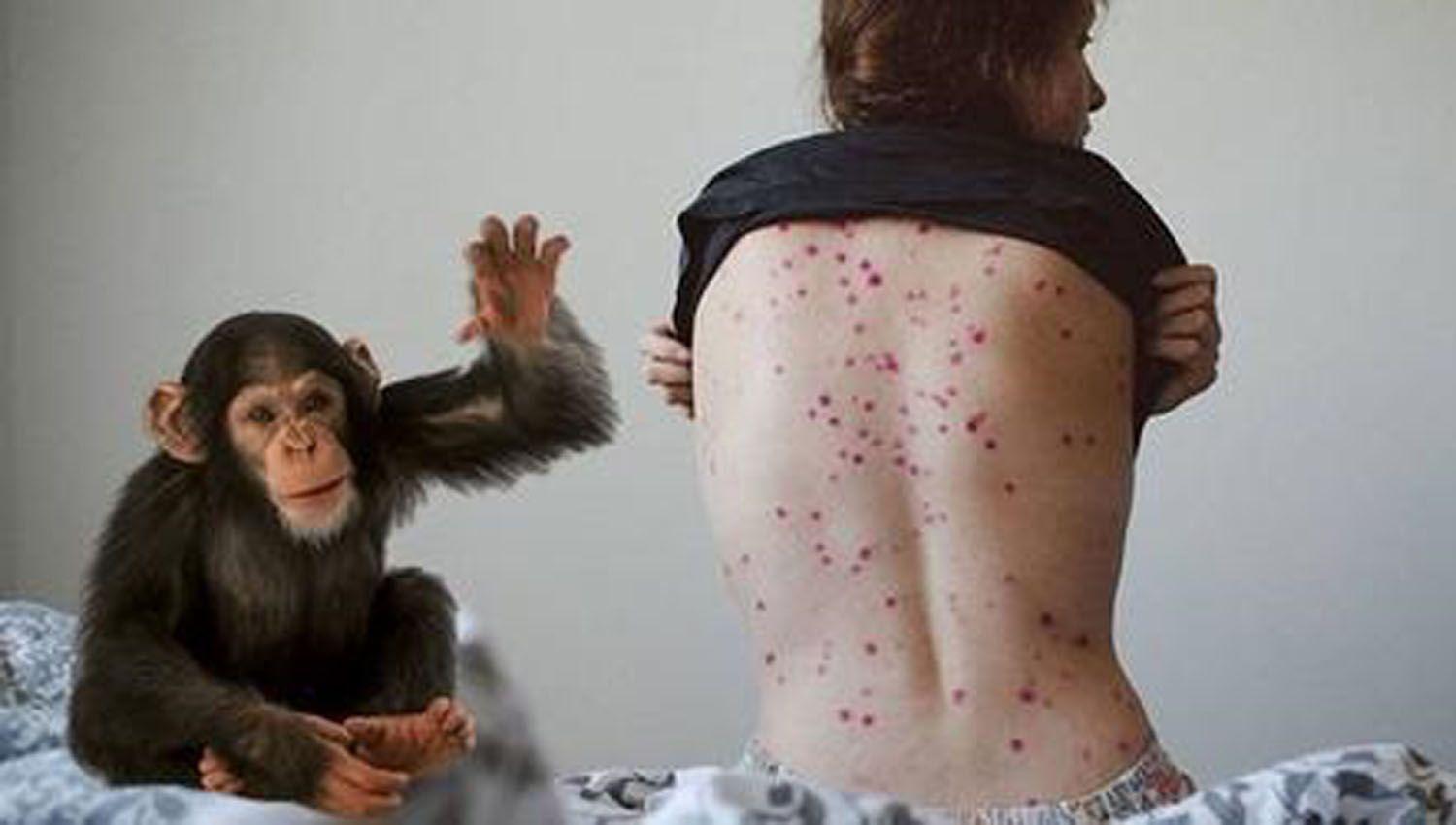 Un experto argentino advirtioacute sobre circulacioacuten asintomaacutetica de viruela del mono