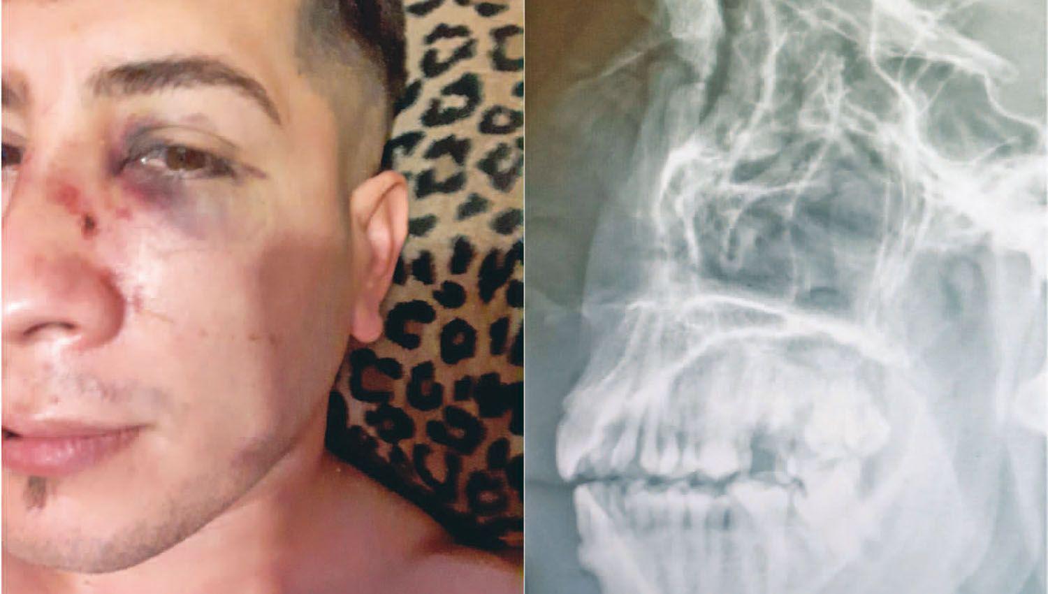 Otra vez los ldquopatovicasrdquo en la mira por una golpiza a un joven al que le fracturaron la nariz