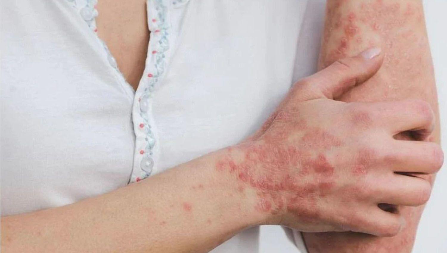 Salud confirmoacute que ascienden a 396 los casos de viruela del mono en la Argentina