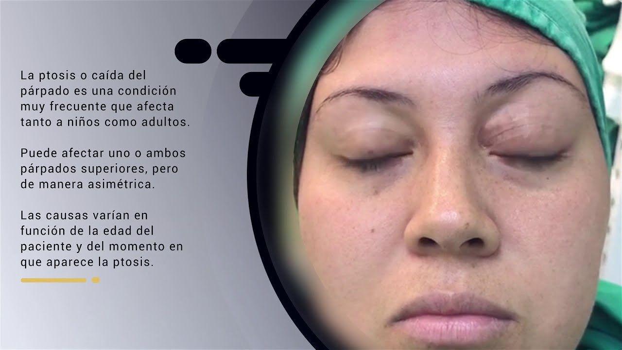 Queacute es la ptosis palpebral la afeccioacuten que sufre el periodista Eduardo Battaglia en sus ojos