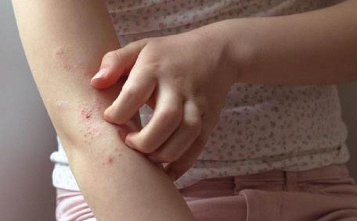 Lanzan campantildea de deteccioacuten gratuita de dermatitis atoacutepica