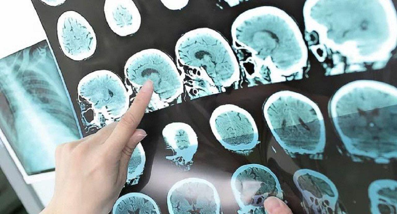 Esclerosis Muacuteltiple- Santiago avanza en el uso de nuevas drogas y terapias no farmacoloacutegicas