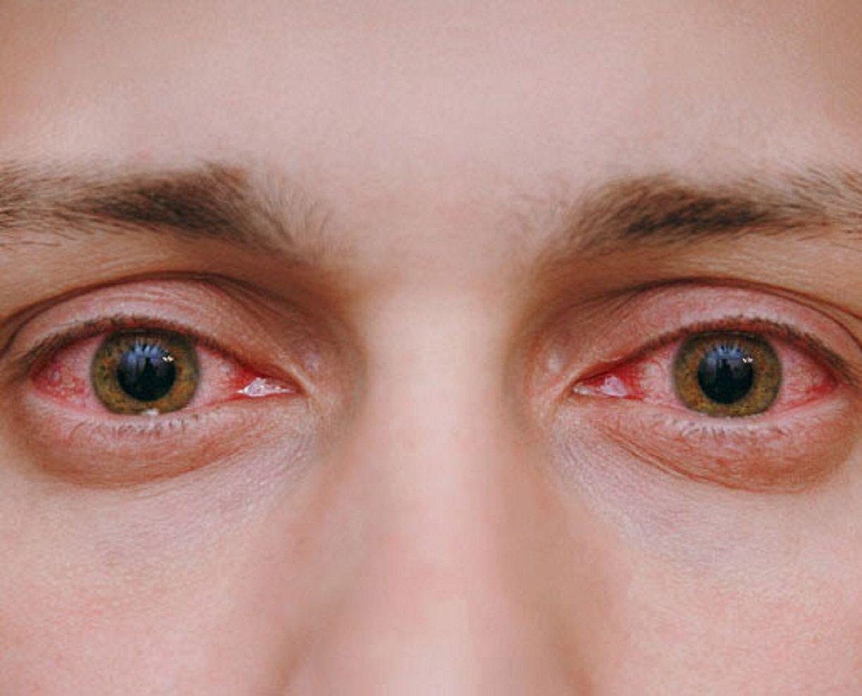 iquestSon peligrosas las venas rojas en los ojos