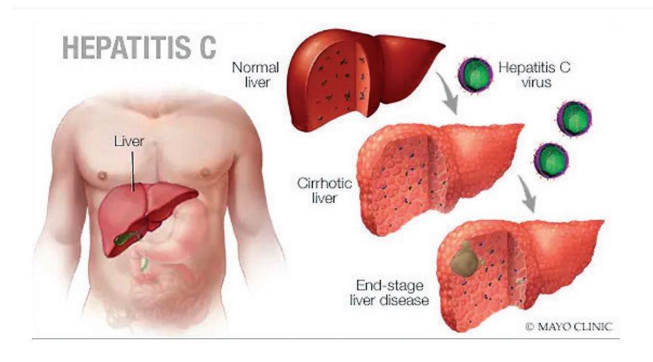 Hepatitis C- en nuestro paiacutes entre 6 y 7 de cada 10 personas que tienen el virus lo ignoran