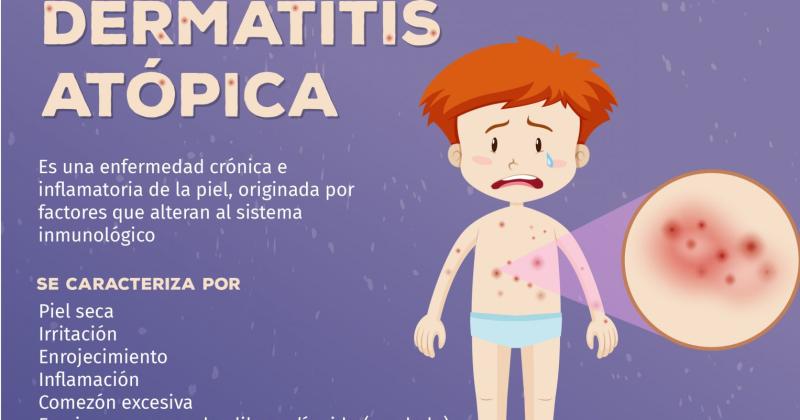 Se registra un notable incremento de casos de dermatitis atoacutepica en los maacutes chicos