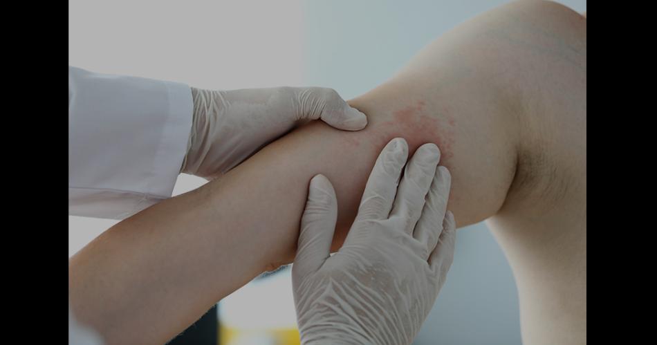 AFECCIÓN Gran parte de la población tendr urticaria en algn momento