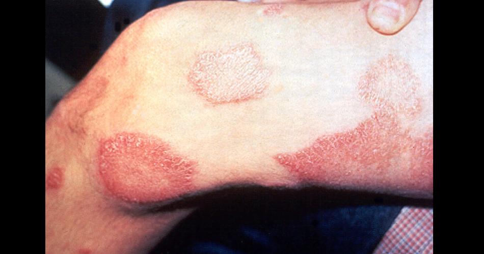 Buscan evitar el estigma que lleva un diagnoacutestico de lepra