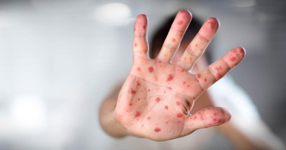 Descubren una nueva variante del sarampioacuten que no detectan las pruebas