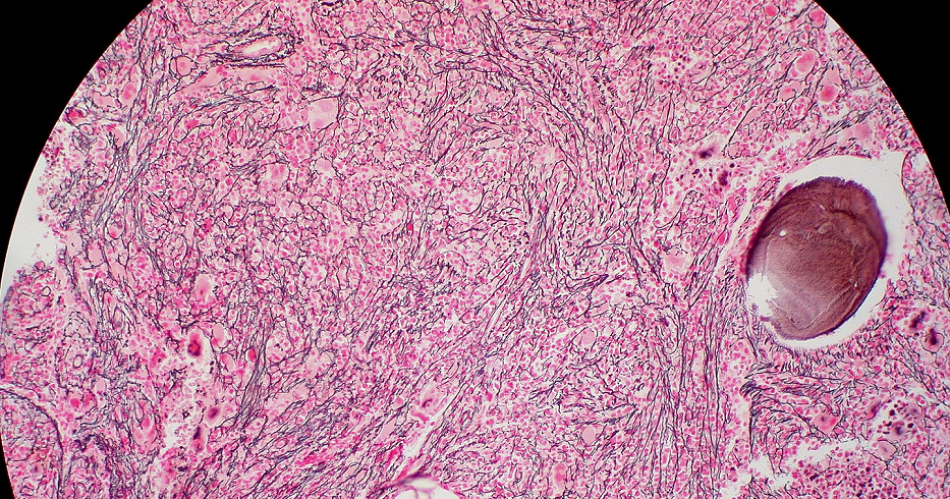 Mielofibrosis una enfermedad tan rara como un antildeo bisiesto