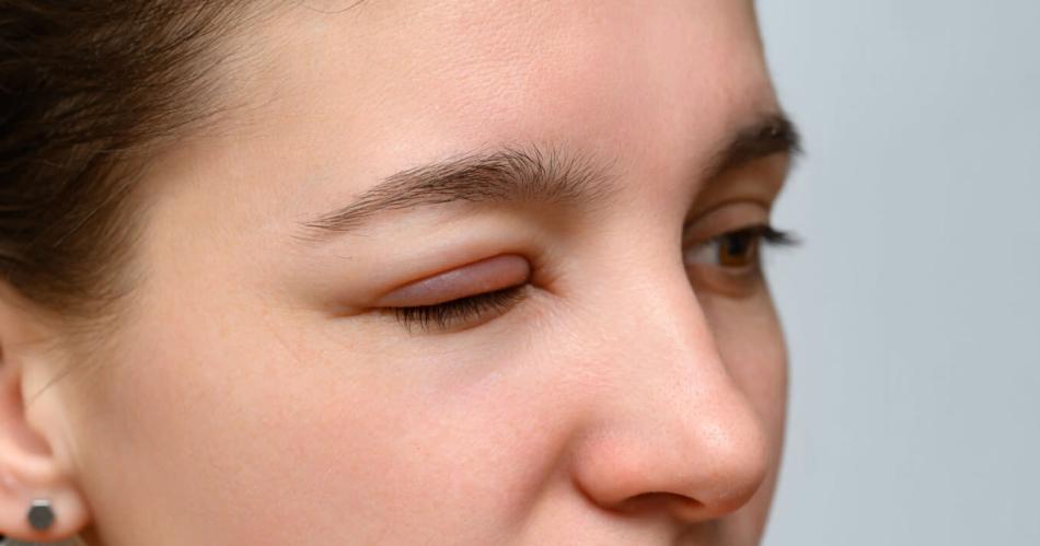 Ojos y paacuterpados hinchados- cuaacuteles son sus causas y tratamiento